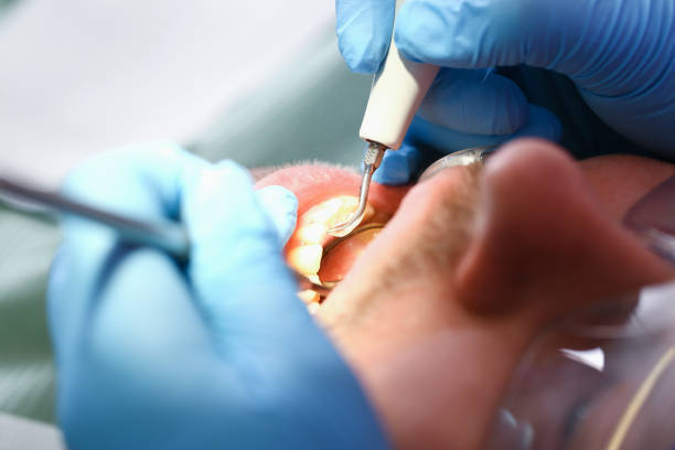 Best Emergency Dentist for Lost Fillings or Crowns in Lakeview, NY